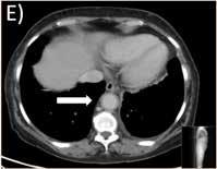 AORTITEN F) Uppföljande F18-FDG PET-CT