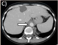 aortaväggsförtjockning  F-G)