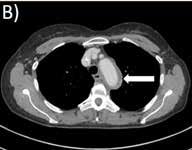 C) F18-FDG PET-CT före händelsen där