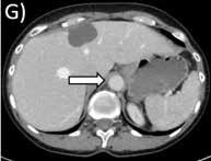 aortabågs- respektive  DT OCH PET-CT