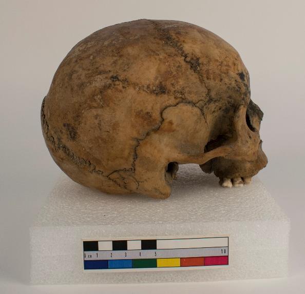3.3. MAC0239A.002 Kranium av man (1911) Ingen underkäke tillhörande detta kranium påträffades.