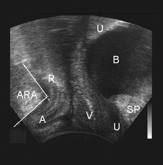 Canal R: Rectum V: Vagina U: