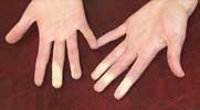 (Raynauds