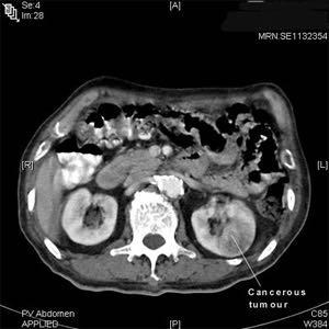 Kartlägga tumören Datortomografi (DT) buk DT thorax Ev.