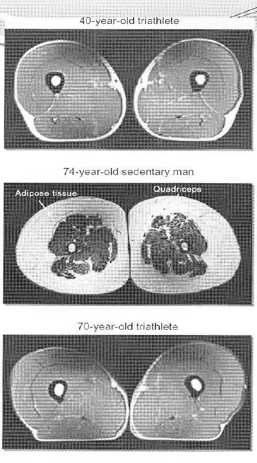 Sarcopeni Tränad 40-åring Stillasittande 74-åring Tränad 70-åring Regelbunden träning enda strategin för att motverka sarcopeni och förbättra