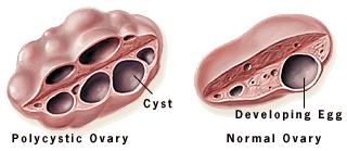 POLYCYSTISKT OVARIALSYNDROM (PCOS) Prevalens 5-10% 70% har anovulation och PCO, 85% hyperandrogena 50% överviktiga/obesa vid diagnos