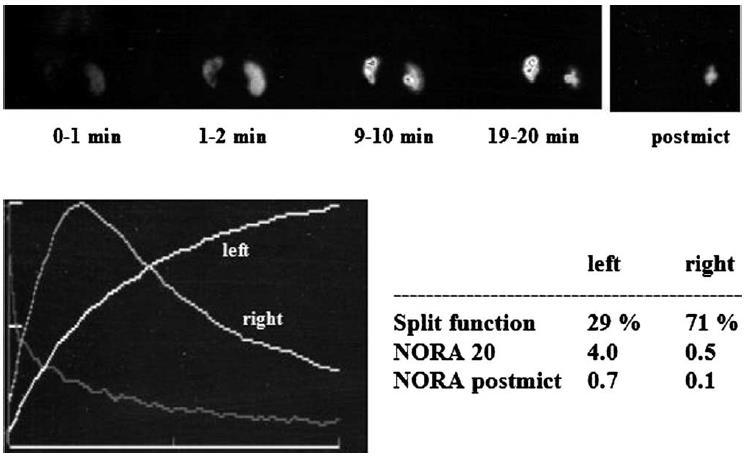 Taghavi et al Urol J. 2007;4:36 40 Piepsz et al SNM 2006;36:16-35. Visuell bedömning a. Njurkurvor b. PM bilder Kvantitativa parametrar Diuretisk T 1/2 (Conway et al SNM 1992;2:74-84.49).