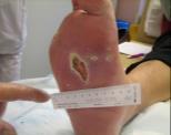 optimera behandlingen av svårläkta sår för att minska lidande och kostnader. Oktober 2011 start av sårmottagning.
