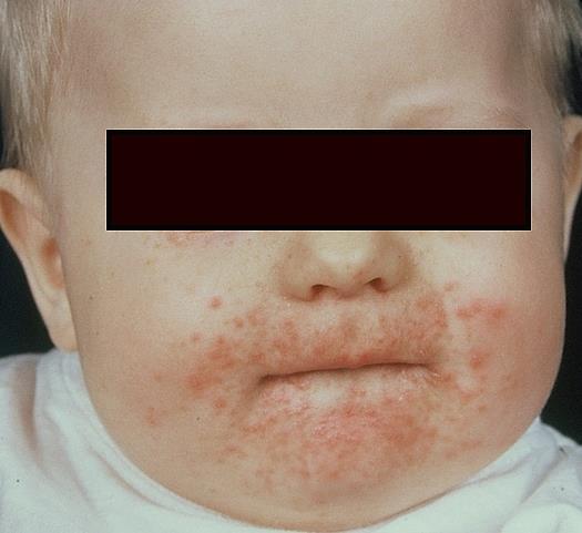 Differentialdiagnoser Perioral dermatit Blandning av papler och pustler. Ibland spridning över kinderna mot ögonen. Området kring det läppröda är ofta sparat vilket sällan är fallet vid eksem.