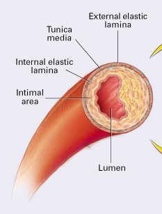 Endothelial denudation - Subintimal hemorrhage - Local dissection - Elastic recoil IFLAMMATORY RESPOSE Vascular