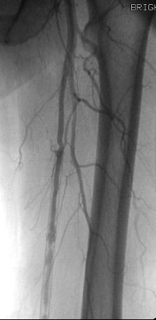 surveillance for recurrent ISR at 1, 3, 6, 9, 12, and 18 months and then yearly Primary endpoint: stent (primary, primary-assisted, and secondary)