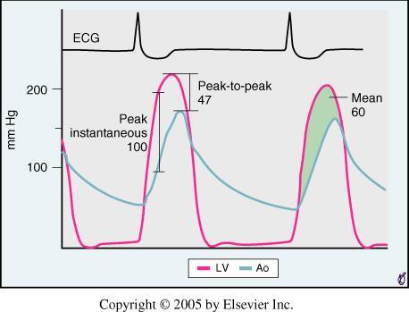 Metodologiska skillnader mellan gradienter deriverade från dopplerflödeshastigeter och invasiva tryckmätning: - Doppler mäter den maximala momentana tryckskillnaden - Hjärtkateterisering mäter