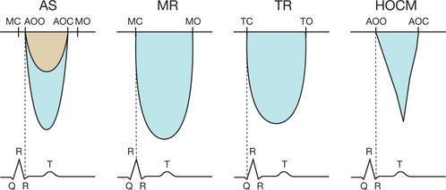 Fallgrop: vs Mitralinsufficiens - Mitralinsufficiensen spektraldoppler kurva har längre duration (ejektionstid + isovolumetriska perioder) -