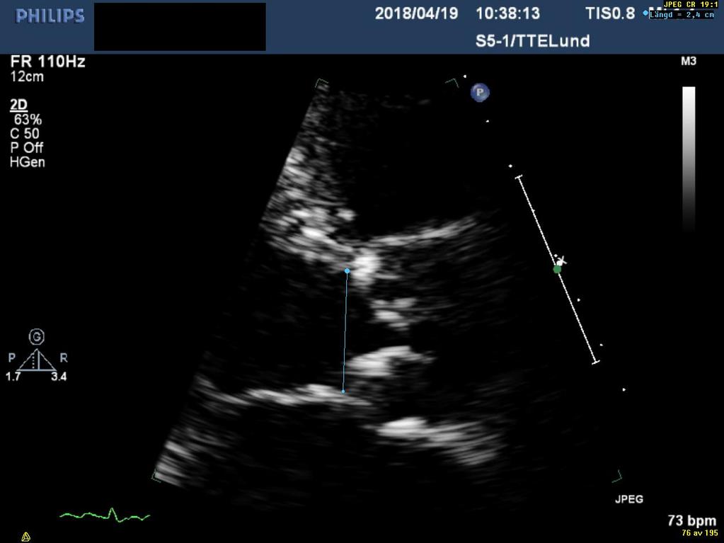 LVOT mätning: Intra- and interobserver variability ~ 5-8 % - Area LVOT = πr 2