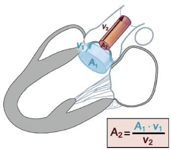 Kontinutetsekvationen: LVOT (area = πr 2 ) VTI-aortaklaff (CW-doppler) VTI-LVOT (PW-doppler) ASE Guidelines 2017 En