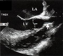 Differential diagnoser: Supravalvulär