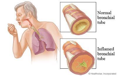 Kronisk bronkit Hosta med upphostningar dagligen under minst tre mån. per år under minst två år.