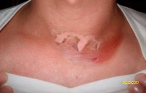 Optisk strålning Effekter på hud UV-strålning Effekt efter kort tid: Bränna oskyddad hud (