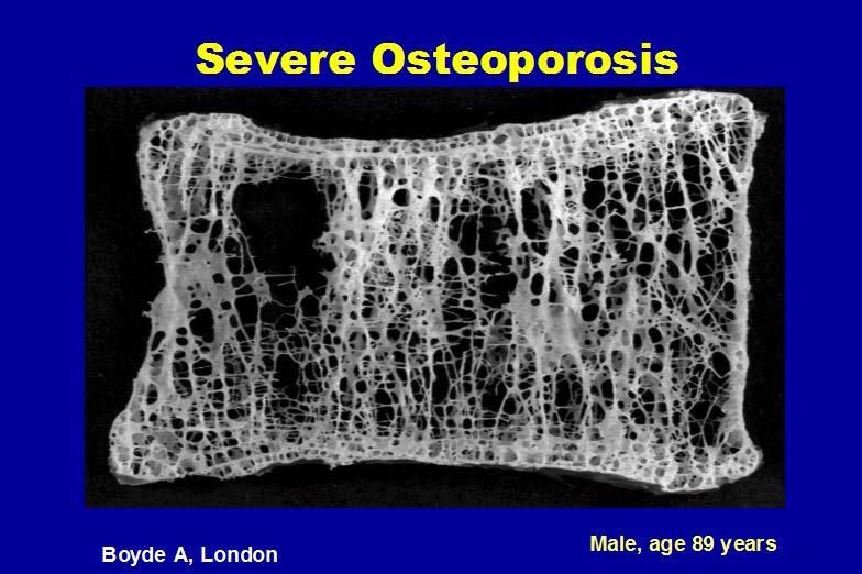 -Hypogonadism