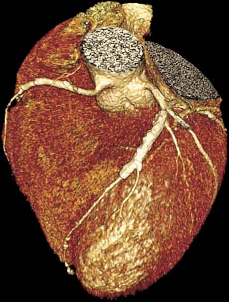 DIAGNOSTIK MED MDCT MDCT (Multi Detector Computed Tomography) the holy grail för coronardiagnostik. Fantasi eller verklighet?