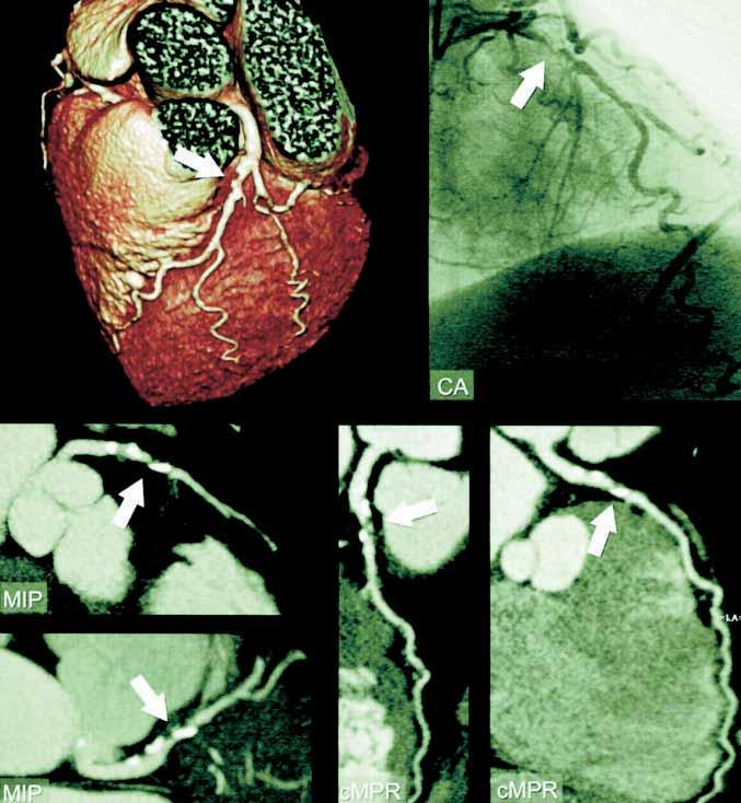 DIAGNOSTIK MED MDCT Tät proximal LAD-stenos (pilen) visad med 3D-bild (vänstra övre), coronarangiografi (högra övre), MIP-projektion (vänstra nedre), curved-mpr (högra två nedre).