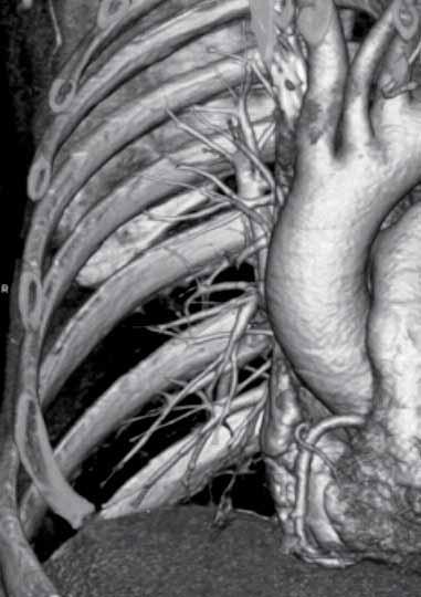 DIAGNOSTIK MED MDCT nifikanta stenoser. Agatstone-score var medel 821 (0-3110) vilket är mycket högt (>75 percentile i en ålders- samt könsmatchad kontrollpopulation).