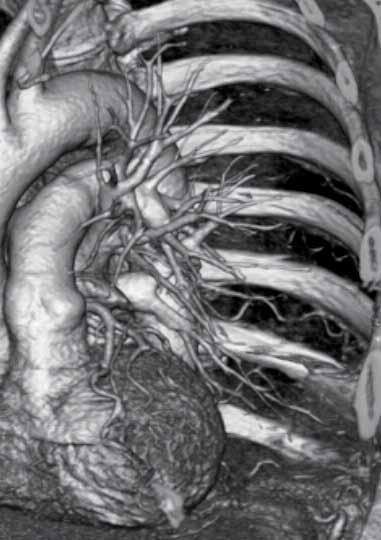 DIAGNOSTIK MED MDCT cardscint detekterade 6/7 av de signifikanta stenoserna det vill säga 85,7% sensitivitet.