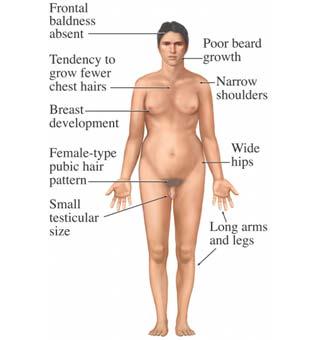 Klinefelters syndrom Problem och symtom: De manliga egenskaperna framträder inte lika tydligt och de utvecklar istället bröst.