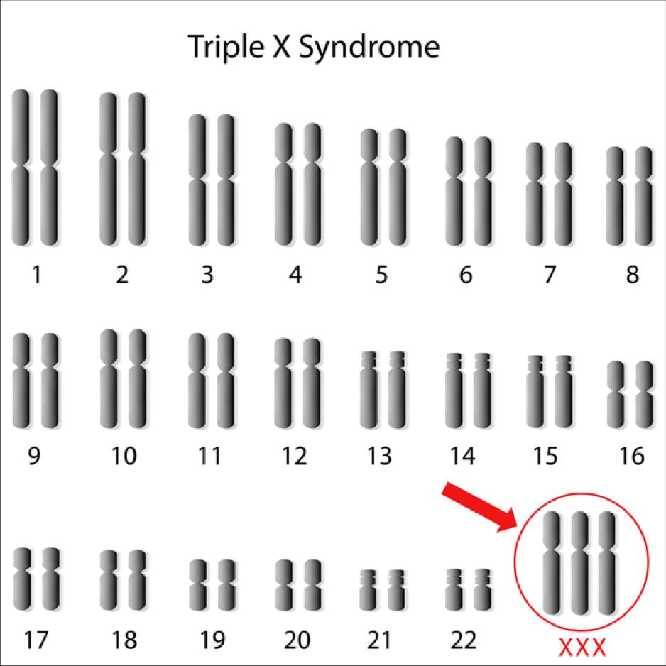 Trippel-X-syndromet Trippel X syndromet beror på att en flicka har tre exemplar av X- kromosomen. Karyotyp: 47,XXX. Förekomst: Förekomsten är 1 på 1 000 kvinnor.