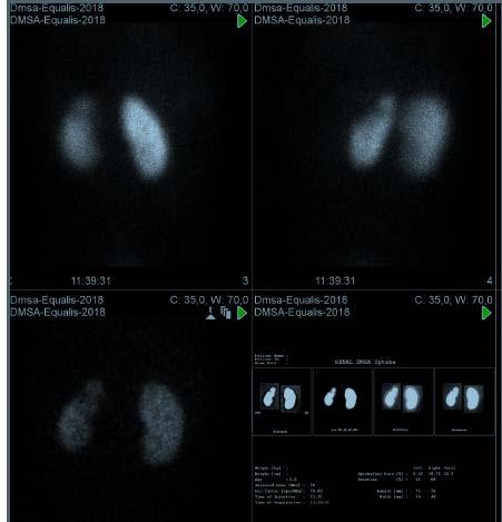 Fall 2 - statisk njurskintigrafi med avgränsbar parenkymdefekt. Svarsförslag från expertgruppen Statisk njurskintigrafi / 99mTc-DMSA-skintigrafi Njurarna har normal lokalisation.