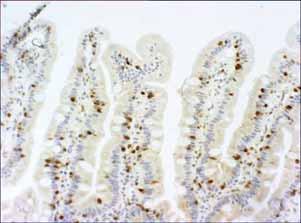 2004 25 IELs/100 epithelial cells should be taken as the upper limit of