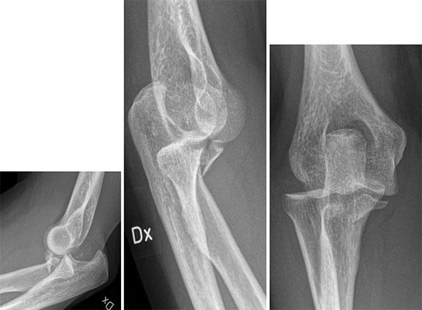 Sida 7 av 24 5. 5p 45-årig kvinna halkar på en isfläck och tar emot sig med höger hand. Skadan är sluten. a) Utifrån slätröntgenbilderna, Vilka anatomiska strukturer är skadade?