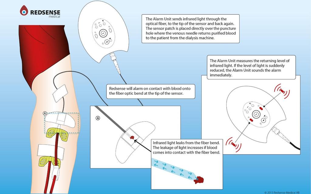 VÅR PRODUKT Redsense består av två delar: en sensor integrerad i ett plåster och därtill en larmenhet. Med hjälp av fiberoptisk teknologi övervakar Redsense kontinuerligt vennålens ingångspunkt.