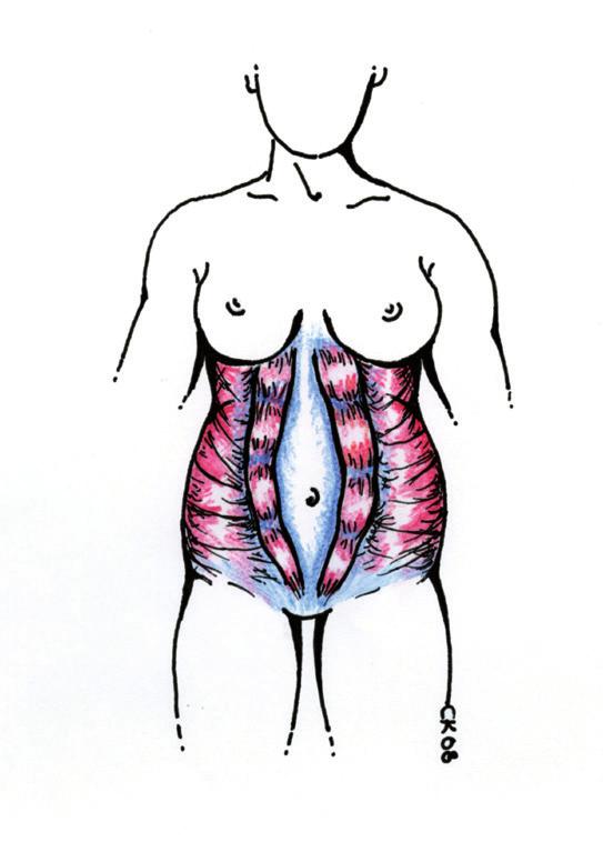 Bukmuskler Bukmusklerna består av flera muskellager och styrkan i dem är viktig för att stödja ryggen.