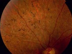 Retinitis Pigmentosa, RP Initialt inga eller diskreta ögonbottenfynd Efter