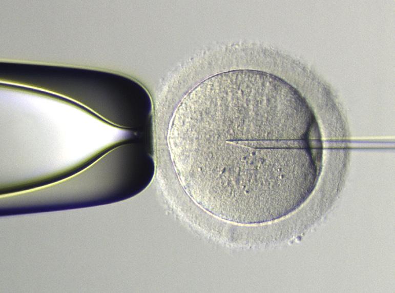 I vissa fall krävs speciell provtagning där man uthämtar spermier direkt från bitestikeln eller testikeln.