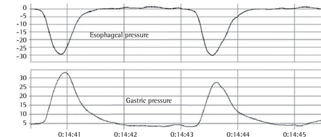 Invasiv / icke samarbete Trans-diaphragmatic pressure: P DI =