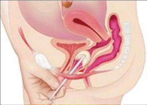 uroterapeut / läkare Nackdel 1: Dyr Nackdel 2: Obekväm