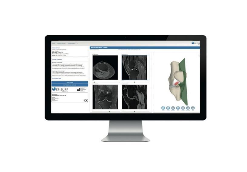 Med hjälp av patientens MR-bilder skapar vi en virtuell 3Dmodell av femursidan av patientens knä, som visualiserar både broskskador och benskador under brosket.