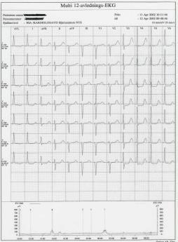 NSTEMI STEMI Plötslig död Debutsymptom AKS: Asymptomatisk Anginadebut - Hjärtinfarkt-