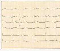 akut PCI även vid tid till angio > 2 timmar Kan patienten ligga på angiobordet inom 90 minuter?