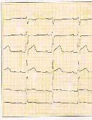 (Fig 2) 2 t Brilique à 90 mg 500 mg ASA Dirigera ambulans till NUS Metalyse (Fig 3) (Rapilysin se fig!