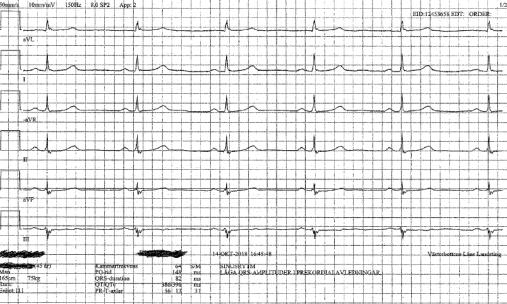 Handläggning AKS på VC Lämnas ej ensamma EKG 112 prio 1 02 om