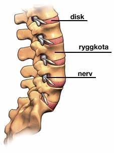 Förklaring av dina besvär Spinalstenos Spinal stenos betyder trång ryggrad.