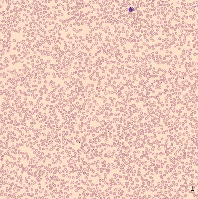 Morfologiska kriterier, fall 6 Färgbarhet Form Stomatocyter (måttligt) (Targetceller) Innehåll Howell-Jolly-kroppar