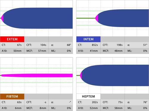 Steg 2.5 Heparineffekt: Vid intraoperativ användning av heparin (kärlkirurgi, cellsaver) eller vid lever-kirurgi kan heparin(oider) påverka koagulationen. Jämför INTEM och HEPTEM.