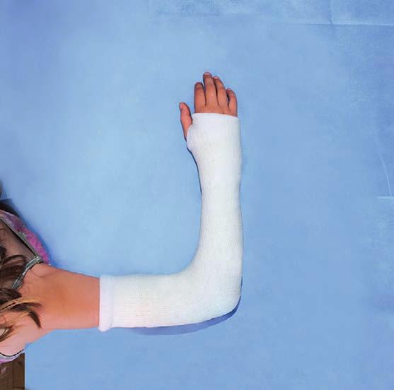 12 Produktsortiment inom immobilisering Syntetiskt gips 3M Scotchcast Poly Premium syntetgips av polyester på rulle Polyester som basmaterial formar sig fullständigt efter kroppen.