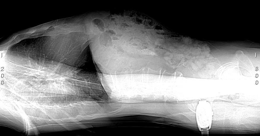 Använd tunna snitt för coronala och sagitella reformeringar (hals 3/2mm och thorax-buk 4/3mm). Ladda in halsgruppen och thorax/bukgruppen var för sig.