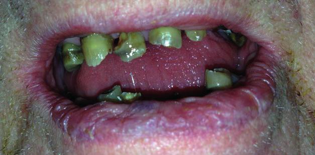 Oral ohälsa Oral ohälsa är motsatsen till oral hälsa. Det kan vara smärta eller obehag från tänder och munhåla, oförmågan att obehindrat kunna tugga olika typer av mat.