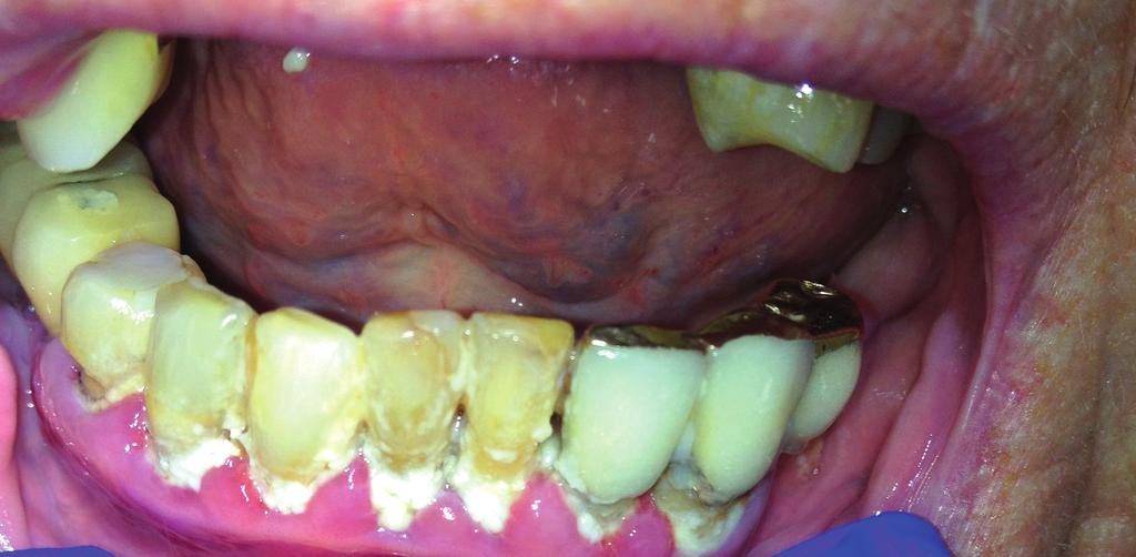 Gingivit Gingivit är en inflammation i tandköttet som orsakas av bakteriebeläggningar (plack) på tänderna vid tandköttskanten.